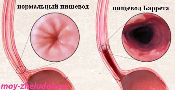 Пищевод Баррета