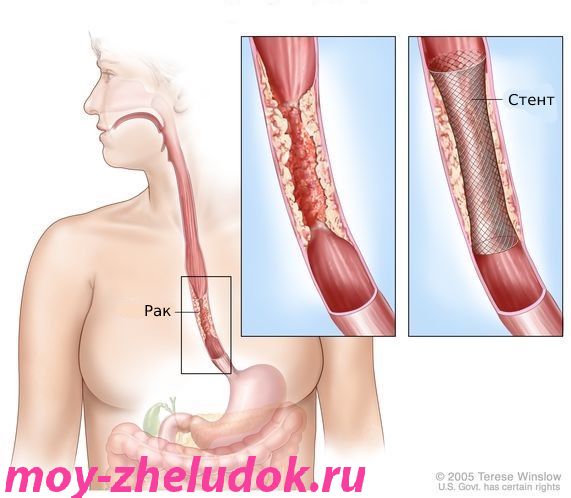 Стентирование пищевода [23]