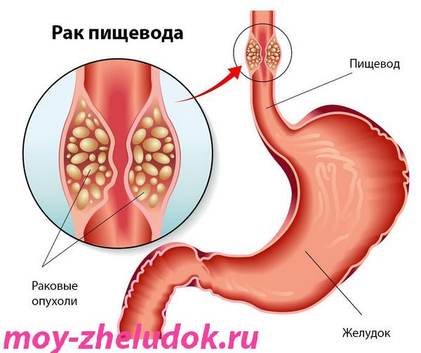 Рак пищевода